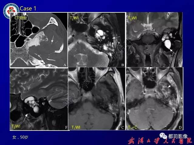 【病例】颞骨巨细胞修复性肉芽肿1例CT及MR影像诊断