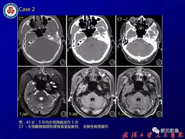 【病例】颞骨巨细胞修复性肉芽肿1例CT及MR影像诊断