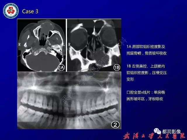 【病例】颞骨巨细胞修复性肉芽肿1例CT及MR影像诊断