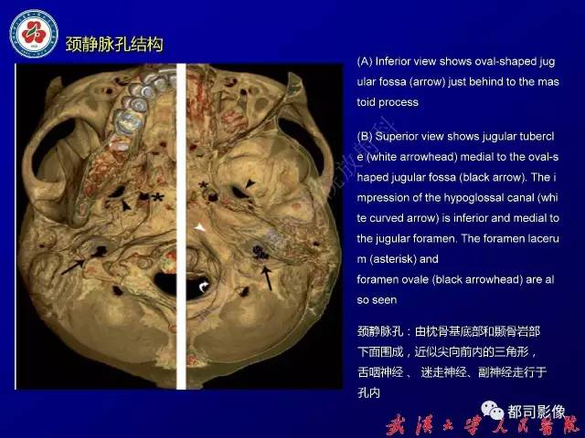 【病例】颞骨巨细胞修复性肉芽肿1例CT及MR影像诊断