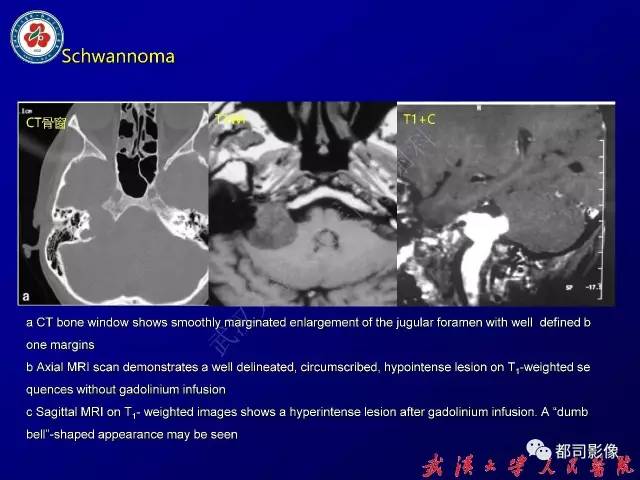 【病例】颞骨巨细胞修复性肉芽肿1例CT及MR影像诊断