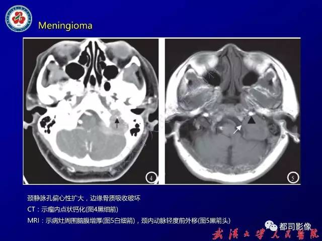 【病例】颞骨巨细胞修复性肉芽肿1例CT及MR影像诊断