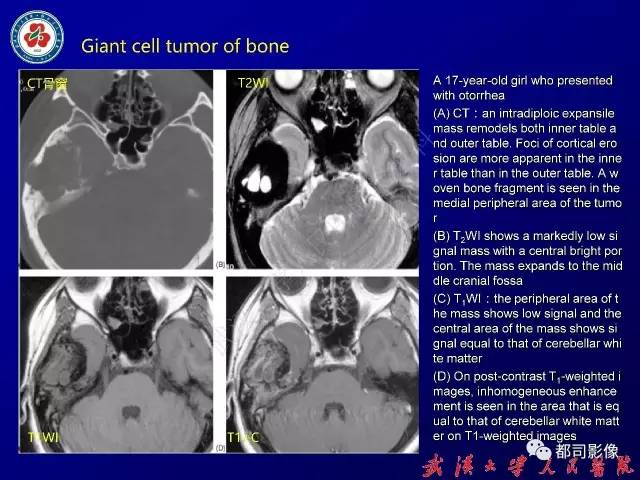 【病例】颞骨巨细胞修复性肉芽肿1例CT及MR影像诊断