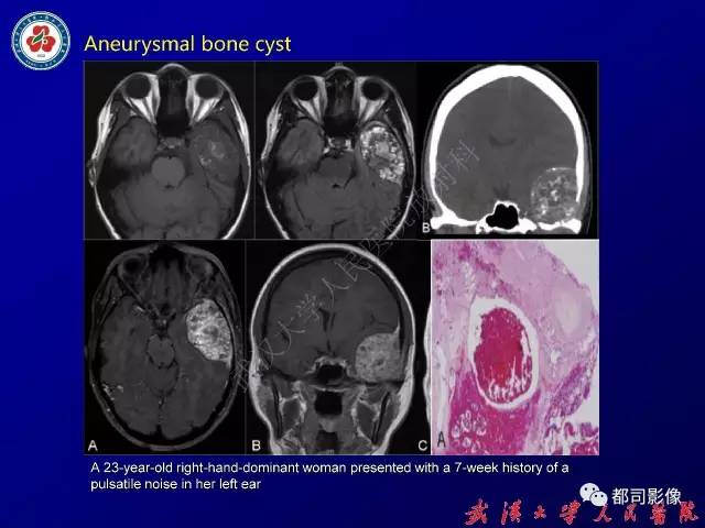【病例】颞骨巨细胞修复性肉芽肿1例CT及MR影像诊断