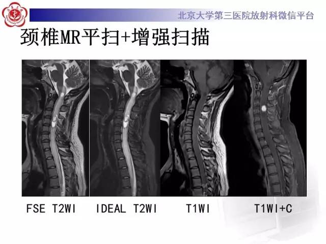 【病例】颈髓血管母细胞瘤1例MR
