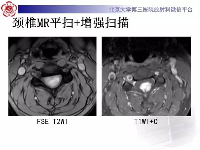 【病例】颈髓血管母细胞瘤1例MR