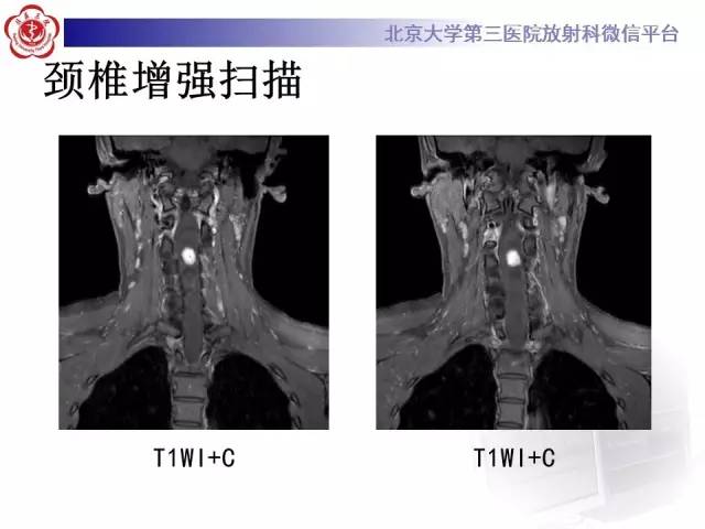 【病例】颈髓血管母细胞瘤1例MR
