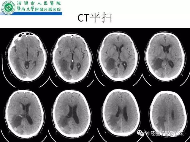【病例】肺腺癌颅内囊性转移瘤1例CT及MR