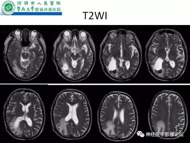 【病例】肺腺癌颅内囊性转移瘤1例CT及MR