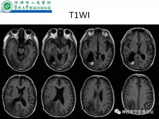 【病例】肺腺癌颅内囊性转移瘤1例CT及MR