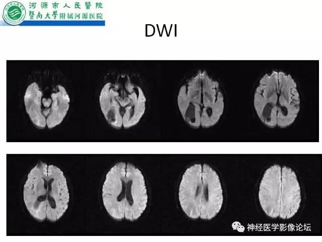 【病例】肺腺癌颅内囊性转移瘤1例CT及MR
