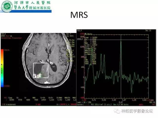 【病例】肺腺癌颅内囊性转移瘤1例CT及MR