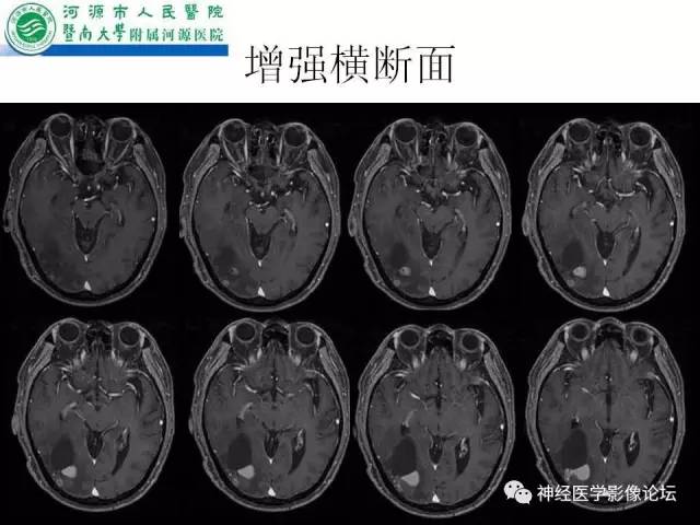 【病例】肺腺癌颅内囊性转移瘤1例CT及MR