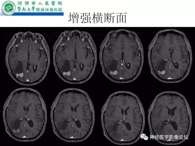 【病例】肺腺癌颅内囊性转移瘤1例CT及MR