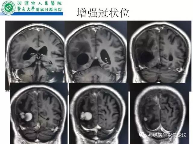 【病例】肺腺癌颅内囊性转移瘤1例CT及MR