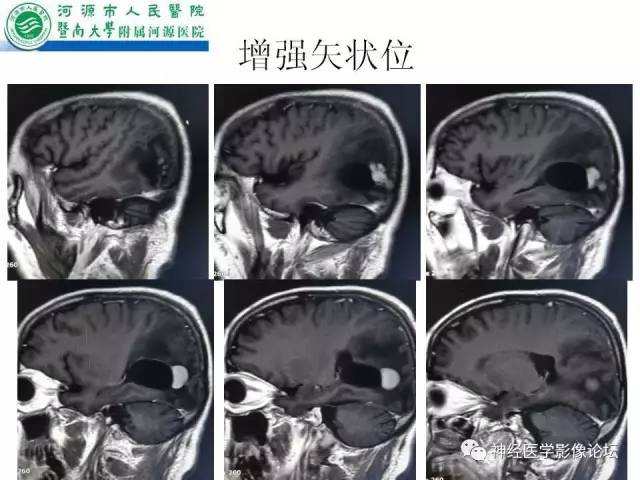【病例】肺腺癌颅内囊性转移瘤1例CT及MR