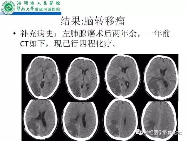 【病例】肺腺癌颅内囊性转移瘤1例CT及MR