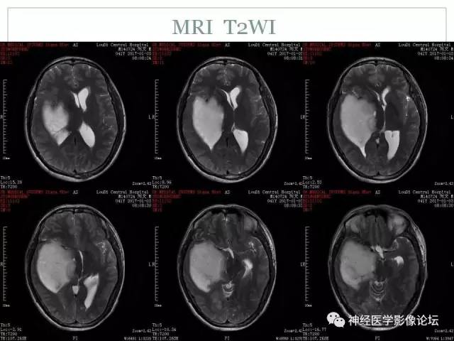 【病例】几乎完全囊变的星形细胞瘤 1例CT及MR