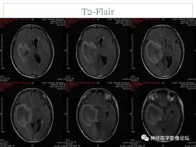 【病例】几乎完全囊变的星形细胞瘤 1例CT及MR