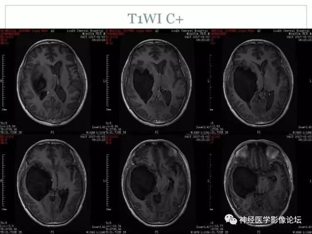 【病例】几乎完全囊变的星形细胞瘤 1例CT及MR