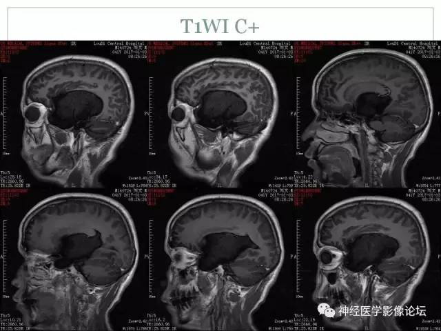 【病例】几乎完全囊变的星形细胞瘤 1例CT及MR