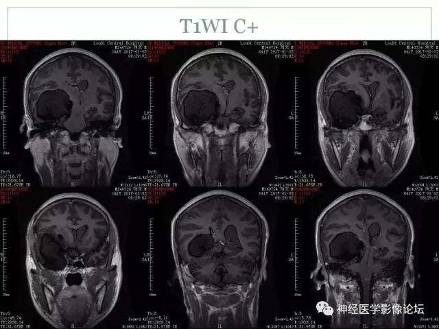 【病例】几乎完全囊变的星形细胞瘤 1例CT及MR