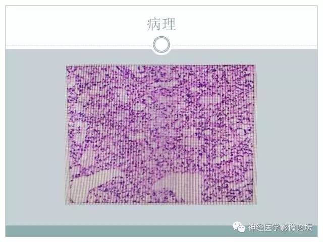 【病例】几乎完全囊变的星形细胞瘤 1例CT及MR