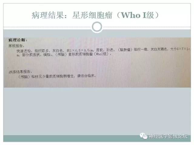【病例】几乎完全囊变的星形细胞瘤 1例CT及MR