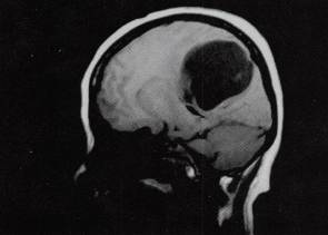 【病例】幕上血管母细胞瘤1例CT及MR 【病例】幕上血管母细胞瘤1例CT及MR