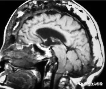 9种弥漫性颅骨增厚的疾病大全