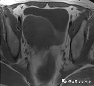 【病例】子宫肌瘤1例MR及CT影像诊断分析 【病例】子宫肌瘤1例MR及CT影像诊断分析