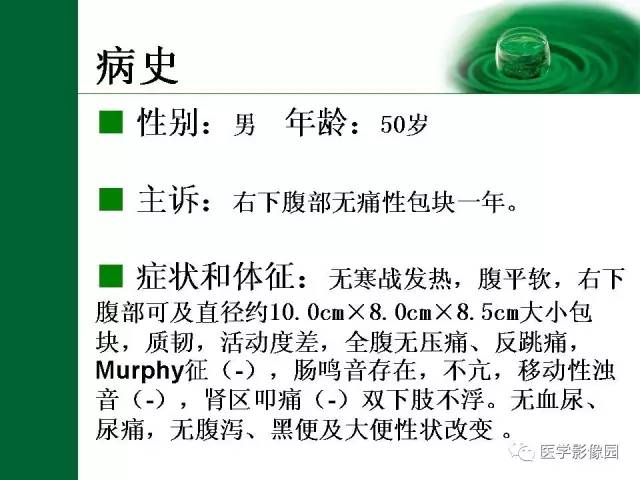 【病例】阑尾粘液腺癌1例CT