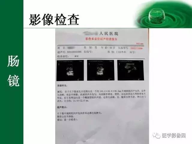 【病例】阑尾粘液腺癌1例CT 【病例】阑尾粘液腺癌1例CT
