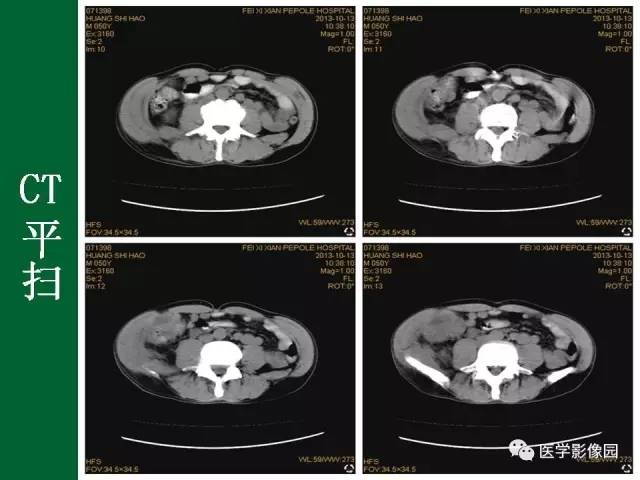 【病例】阑尾粘液腺癌1例CT 【病例】阑尾粘液腺癌1例CT