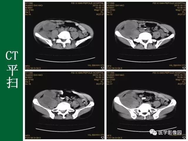 【病例】阑尾粘液腺癌1例CT 【病例】阑尾粘液腺癌1例CT