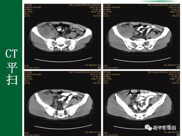 【病例】阑尾粘液腺癌1例CT 【病例】阑尾粘液腺癌1例CT