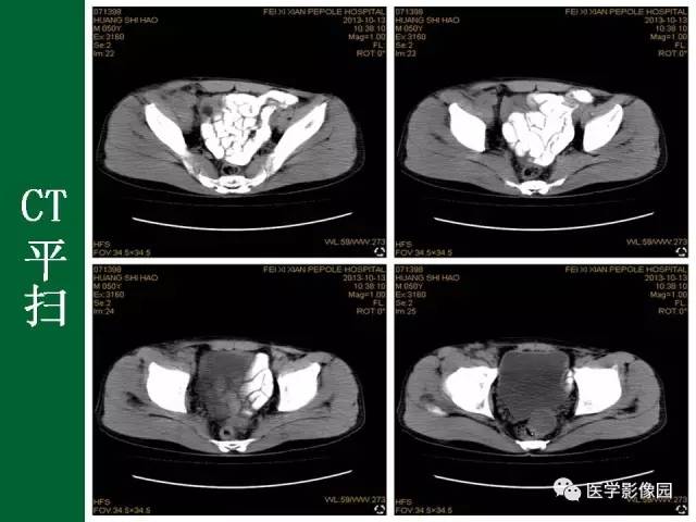 【病例】阑尾粘液腺癌1例CT 【病例】阑尾粘液腺癌1例CT