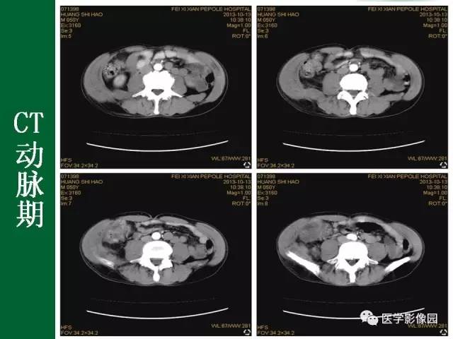 【病例】阑尾粘液腺癌1例CT 【病例】阑尾粘液腺癌1例CT