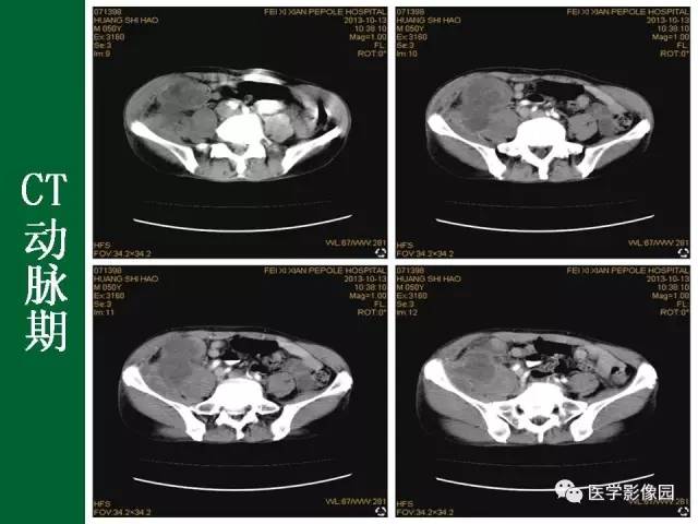 【病例】阑尾粘液腺癌1例CT 【病例】阑尾粘液腺癌1例CT