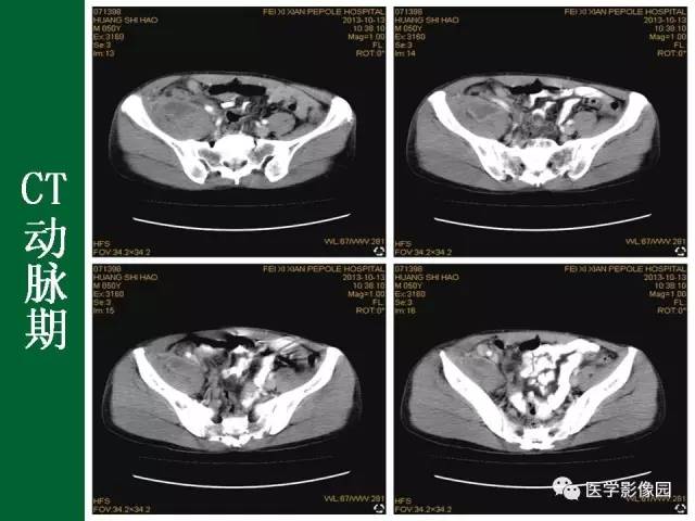 【病例】阑尾粘液腺癌1例CT 【病例】阑尾粘液腺癌1例CT