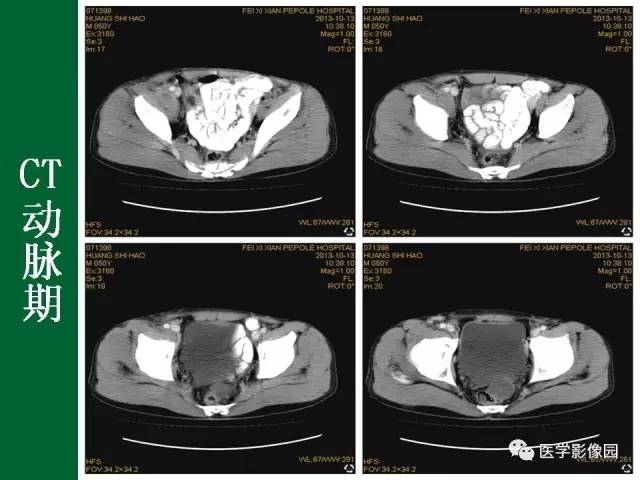 【病例】阑尾粘液腺癌1例CT 【病例】阑尾粘液腺癌1例CT
