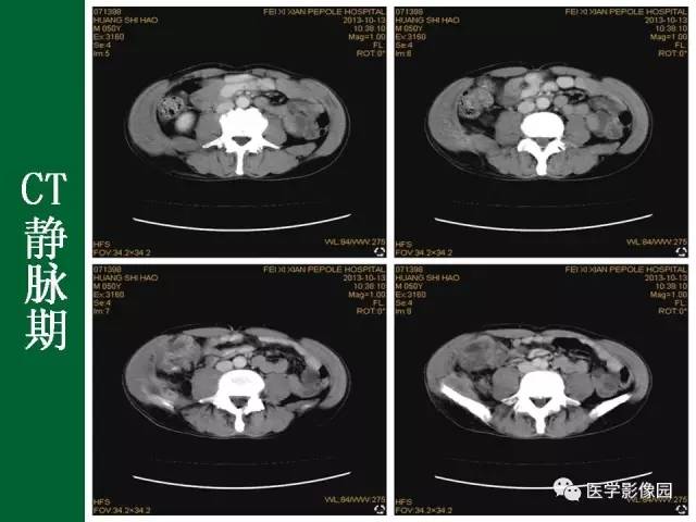 【病例】阑尾粘液腺癌1例CT 【病例】阑尾粘液腺癌1例CT