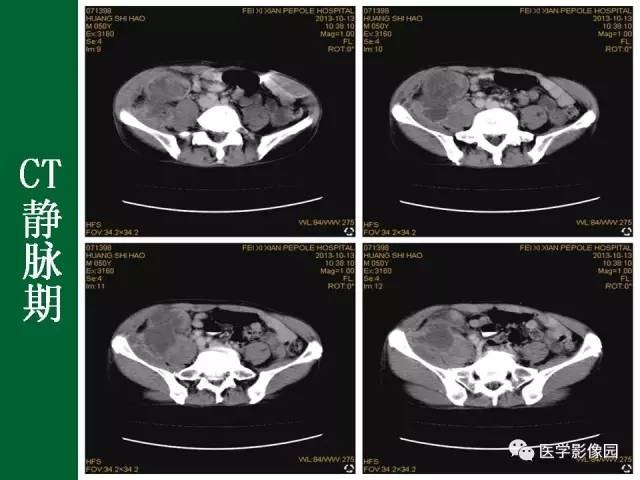 【病例】阑尾粘液腺癌1例CT 【病例】阑尾粘液腺癌1例CT