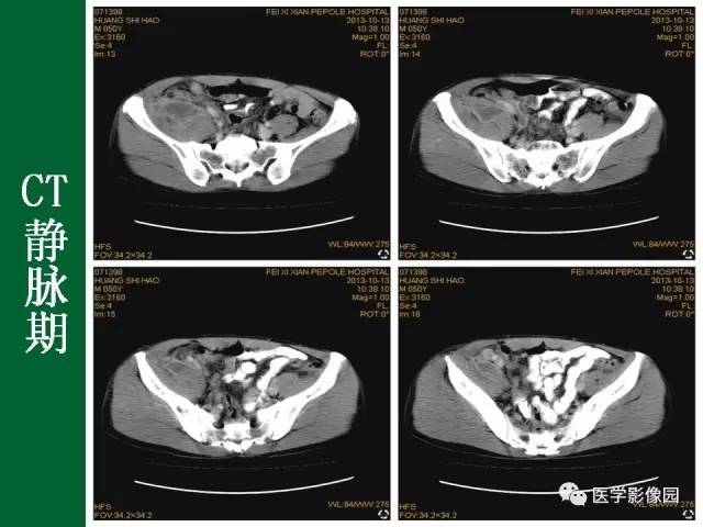 【病例】阑尾粘液腺癌1例CT 【病例】阑尾粘液腺癌1例CT
