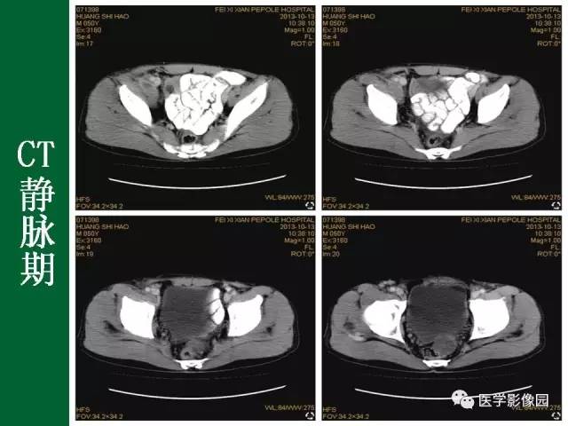 【病例】阑尾粘液腺癌1例CT 【病例】阑尾粘液腺癌1例CT