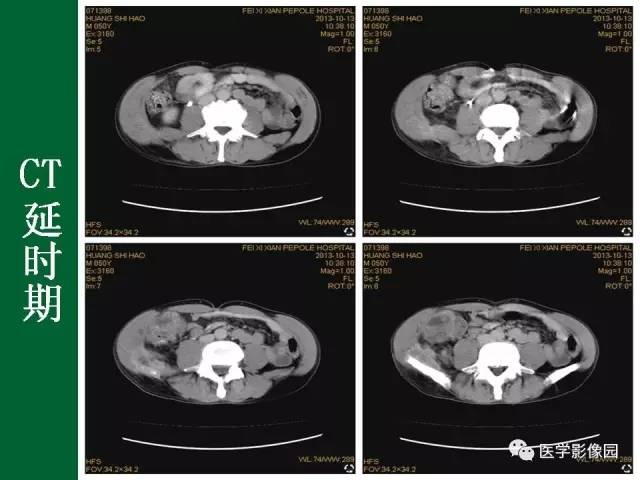【病例】阑尾粘液腺癌1例CT 【病例】阑尾粘液腺癌1例CT