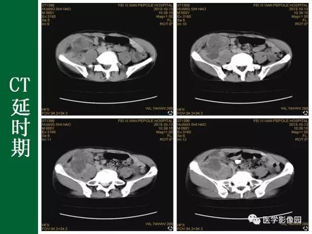 【病例】阑尾粘液腺癌1例CT 【病例】阑尾粘液腺癌1例CT