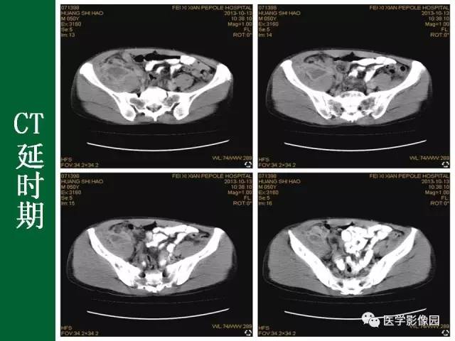 【病例】阑尾粘液腺癌1例CT 【病例】阑尾粘液腺癌1例CT