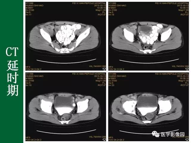 【病例】阑尾粘液腺癌1例CT 【病例】阑尾粘液腺癌1例CT