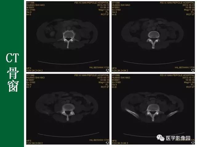 【病例】阑尾粘液腺癌1例CT 【病例】阑尾粘液腺癌1例CT
